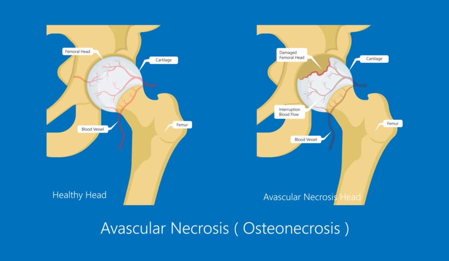 Diagram showing the hip condition avascular necrosis (osteonecrosis)