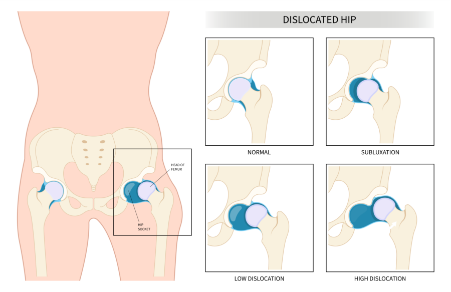Diagram showing a dislocated hip