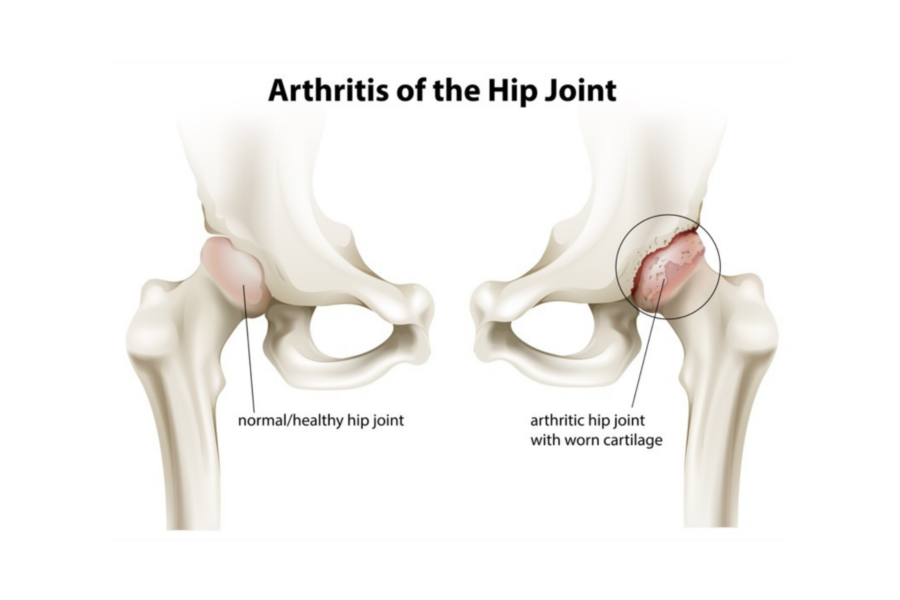 Diagram showing arthritis of the hip joint