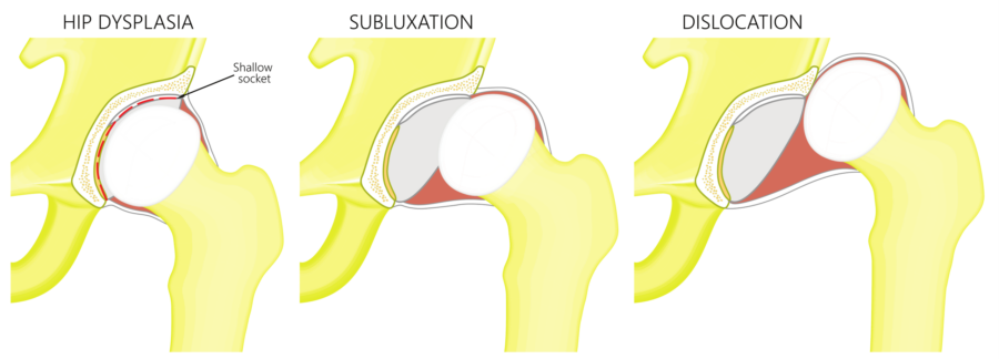 Diagram showing hip dysplasia, sublaxation and dislocation