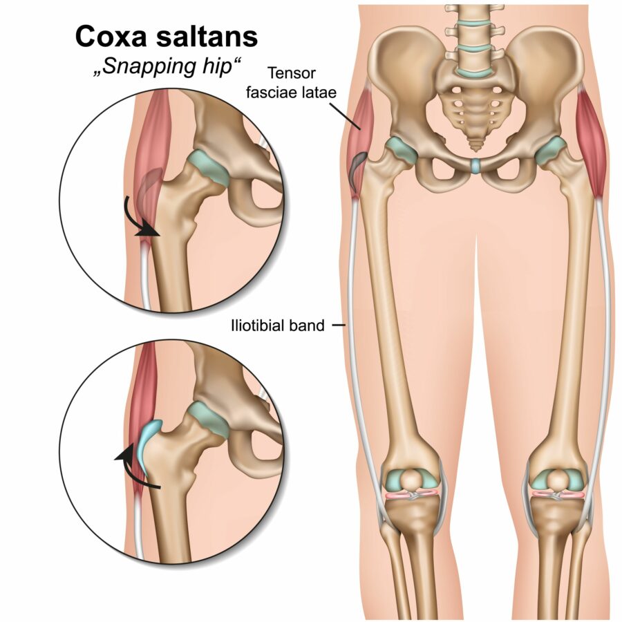Diagram showing the hip condition snapping hip syndrome (coxa saltans)