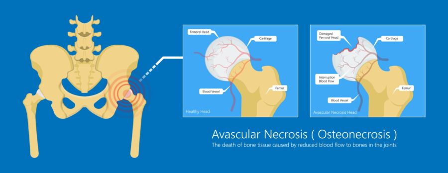 Diagram showing the hip condition avascular necrosis (osteonecrosis)