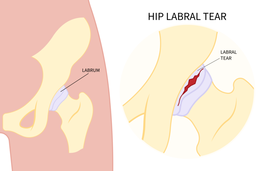 Diagram showing the hip condition labral tear