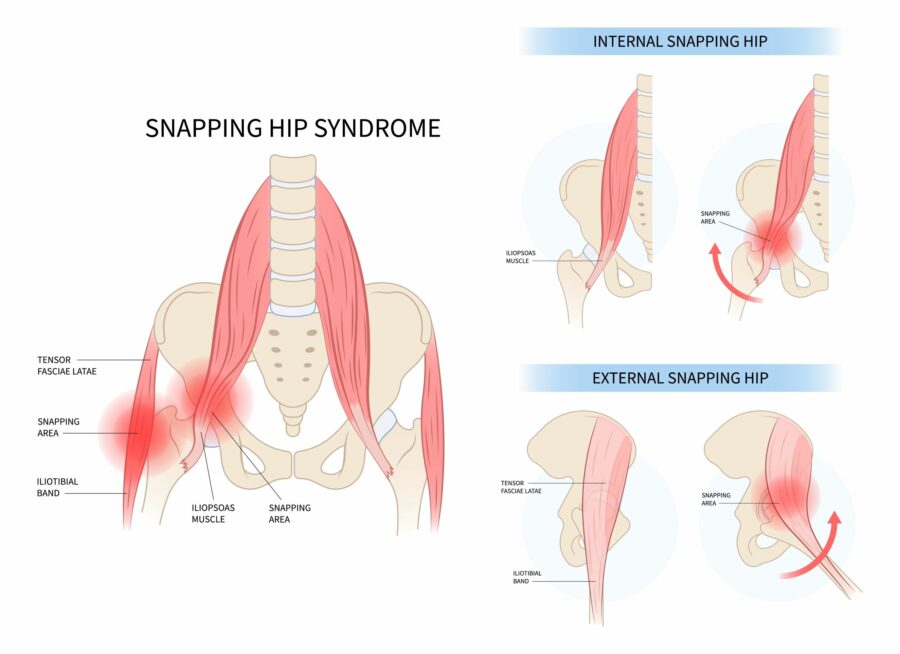 Diagram showing the hip condition snapping hip syndrome